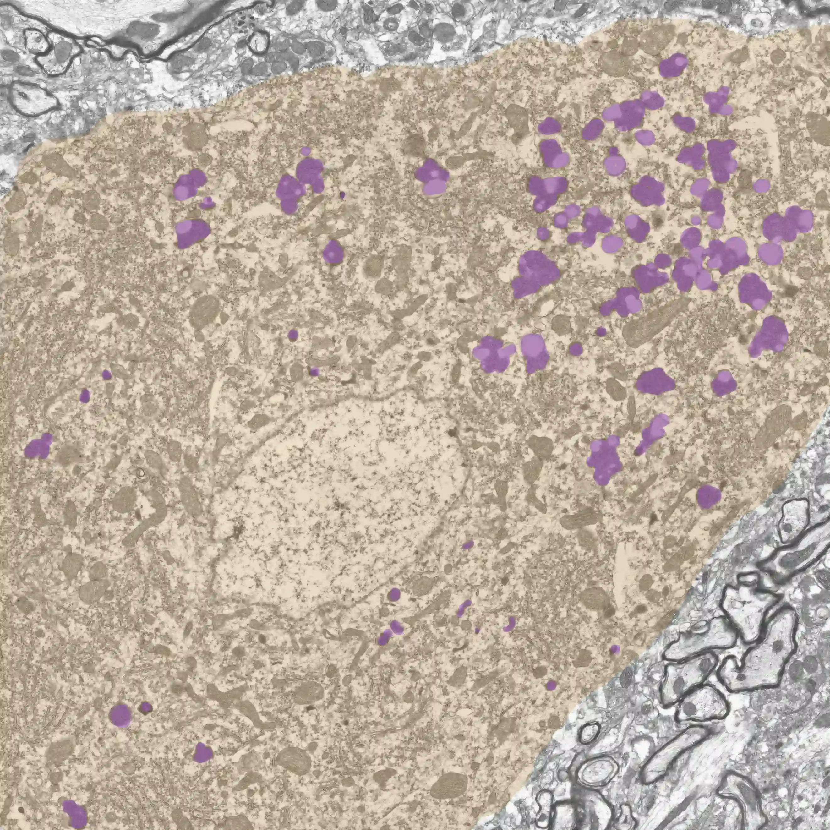 image of motor neuron with disease pathology